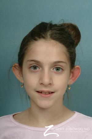 Otoplasty: Patient 6 - Before Image 1