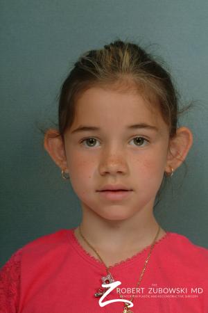 Otoplasty: Patient 4 - Before Image 1