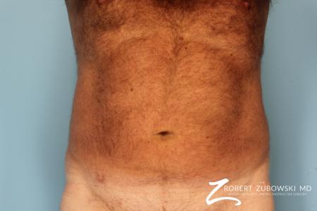 Liposuction: Patient 18 - Before Image 1
