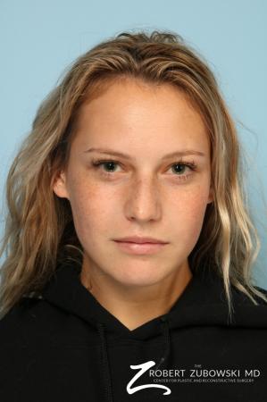 Rhinoplasty: Patient 23 - Before Image 1