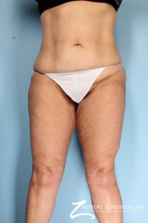 Thigh Lift: Patient 2 - After Image 1