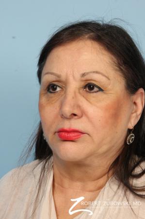 Blepharoplasty: Patient 35 - Before and After Image 2