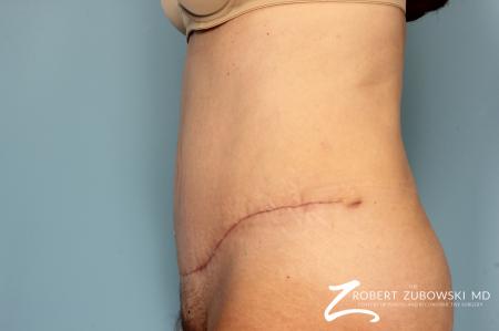 Tummy Tuck: Patient 16 - After Image 2