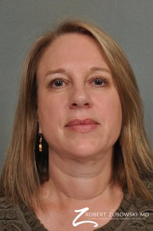Blepharoplasty: Patient 22 - Before Image 1