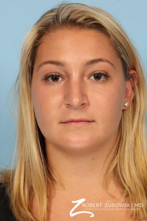 Rhinoplasty: Patient 18 - After Image 1