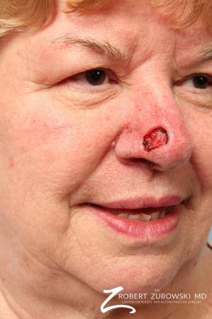 Mohs Closure: Patient 6 - Before Image 1