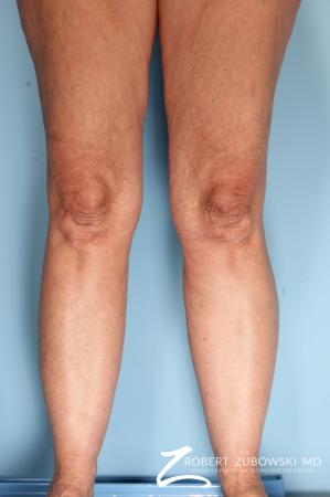 Liposuction: Patient 46 - Before and After Image 2