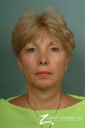 Liposuction: Patient 3 - After Image 1