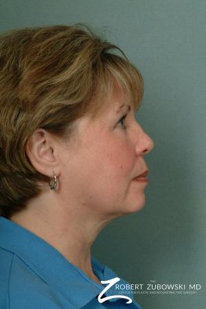 Chin Augmentation: Patient 2 - Before and After Image 2