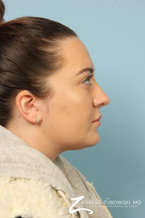 Rhinoplasty: Patient 21 - After Image 3