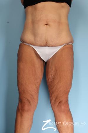 Thigh Lift: Patient 2 - Before Image 1
