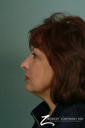 Facelift: Patient 2 - Before and After Image 2