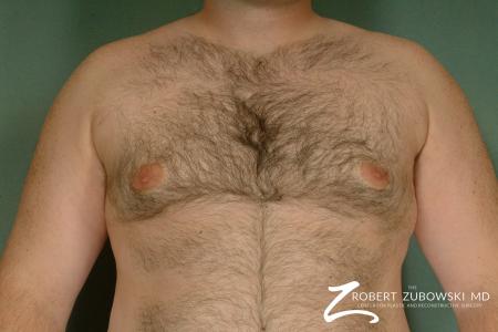 Gynecomastia: Patient 7 - After Image 1
