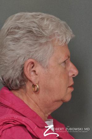 Blepharoplasty: Patient 24 - Before and After Image 2