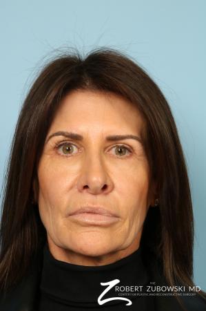 Lip Augmentation: Patient 1 - After Image 1