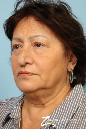 Blepharoplasty: Patient 31 - Before and After Image 2
