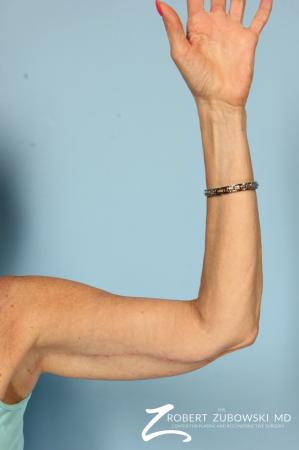 Brachioplasty: Patient 1 - After Image 3