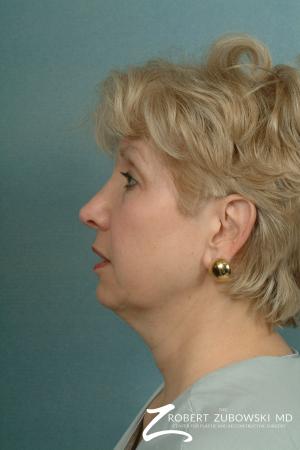 Neck Lift: Patient 2 - Before and After Image 2