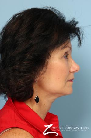 Blepharoplasty: Patient 25 - After Image 2