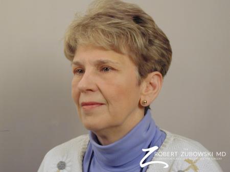 Blepharoplasty: Patient 20 - After Image 2