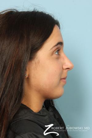 Rhinoplasty: Patient 24 - After Image 2