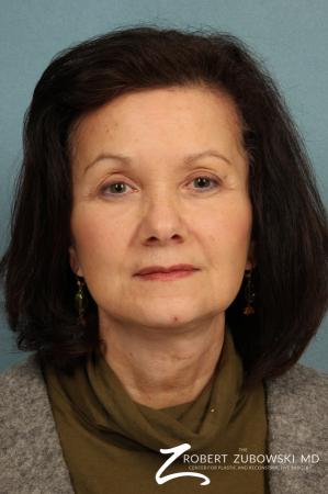 Facelift: Patient 22 - After Image 1