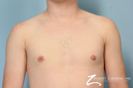 Gynecomastia: Patient 11 - After Image 1