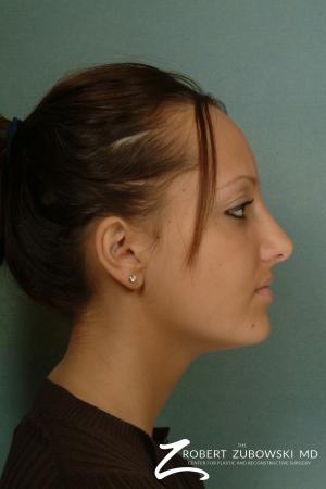 Rhinoplasty: Patient 9 - After Image 2