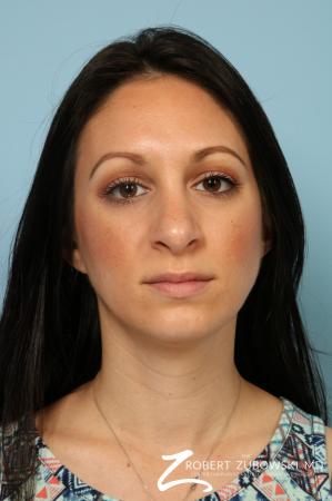 Rhinoplasty: Patient 25 - After Image 1