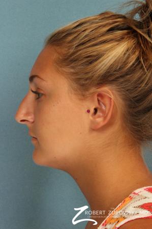 Rhinoplasty: Patient 18 - Before and After Image 2
