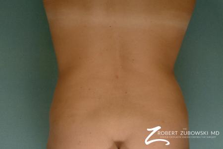 Liposuction: Patient 26 - After Image 3