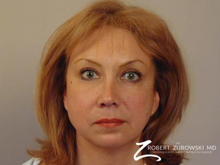Blepharoplasty: Patient 19 - After Image 1