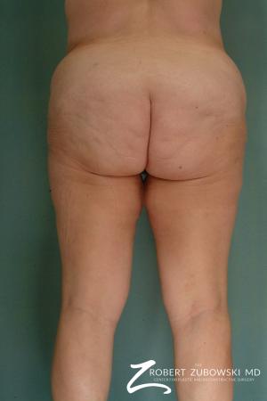 Body Lift: Patient 3 - Before and After Image 2