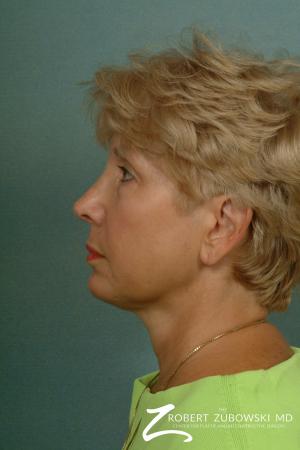 Neck Lift: Patient 2 - After Image 2