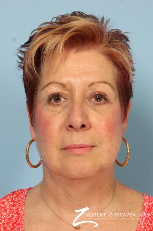 Blepharoplasty: Patient 13 - After Image 1