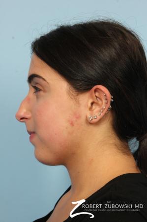 Rhinoplasty: Patient 24 - Before and After Image 3