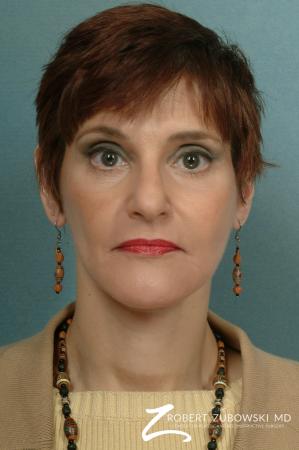 Facelift: Patient 9 - After Image 1