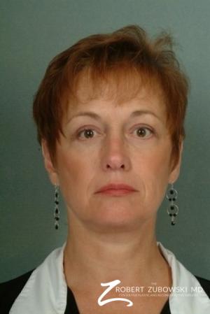 Blepharoplasty: Patient 1 - After Image 1