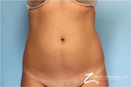 Liposuction: Patient 40 - Before Image 1