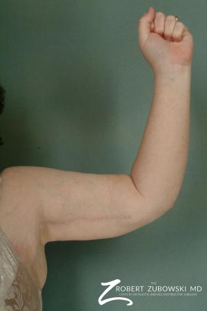 Arm Lift: Patient 3 - After Image 1