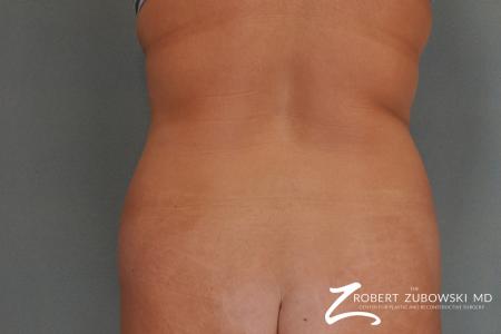 Liposuction: Patient 20 - Before Image 1