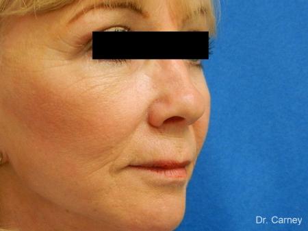 Virginia Beach Facelift 1262 - After Image 3