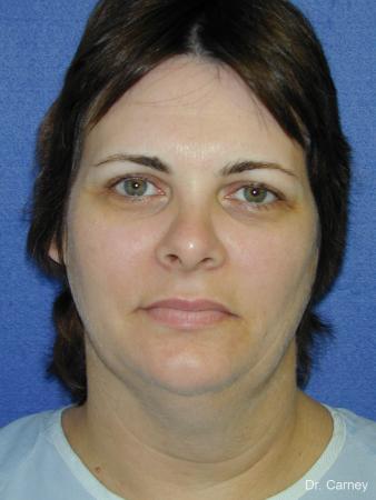 Virginia Beach Neck Lift 1269 - Before and After Image 3