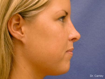 Virginia Beach Rhinoplasty 1218 - After Image 1