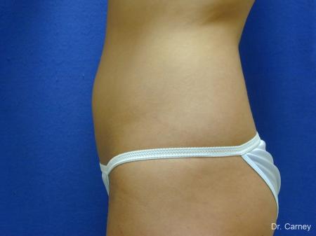 Virginia Beach Liposuction 1277 - Before and After Image 5