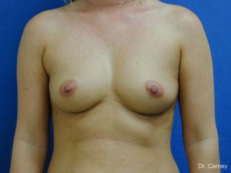 Virginia Beach Breast Augmentation 1192 - Before Image 1