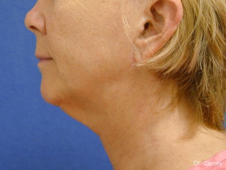 Virginia Beach Neck Lift 1264 - Before Image 1
