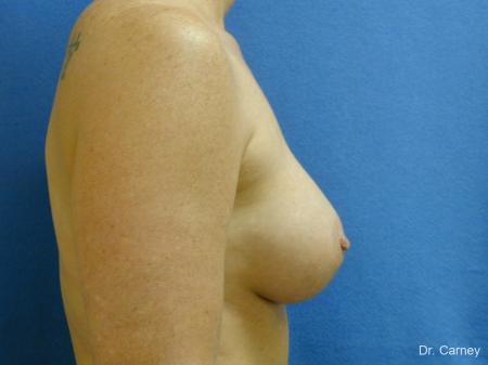 Virginia Beach Breast Augmentation 1214 - After Image 3