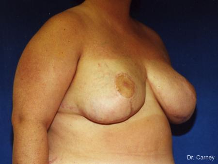 Virginia Beach Breast Reduction 1232 - After Image 1