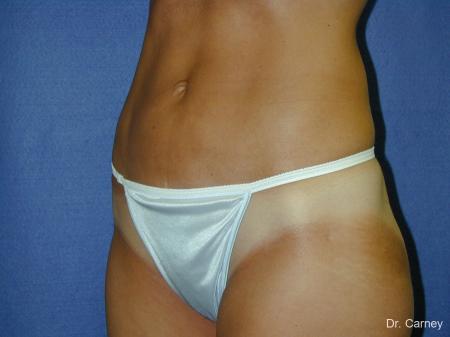 Virginia Beach Liposuction 1282 - After Image 4